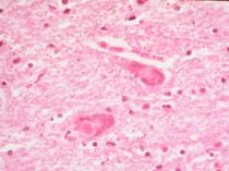 Weefsel toont Lewy body's disease aan.