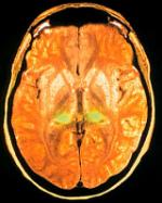 MRI-scan die de ziekte Creutzfeld Jacob laat zien.