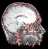 MRI scan van de hersens