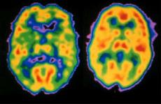 Petscan met links de hersens van iemand met schizofrenie, rechts van een gezond persoon.